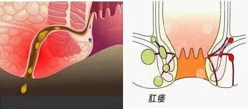 🌟肛瘘最新治疗方法，告别病痛，重拾健康光彩！