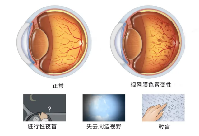 视网膜色素变性治疗的最新进展研究及突破